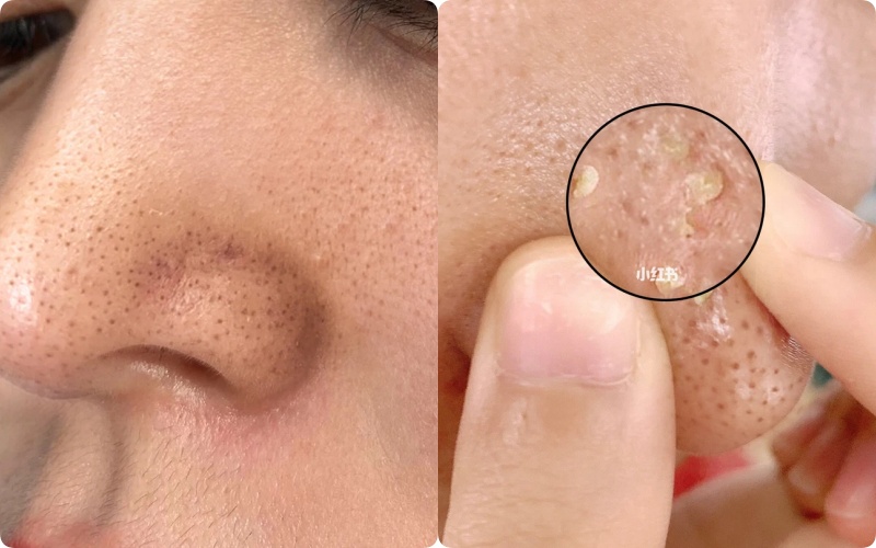 Nhân Mụn Trồi Lên Có Nên Nặn Không?