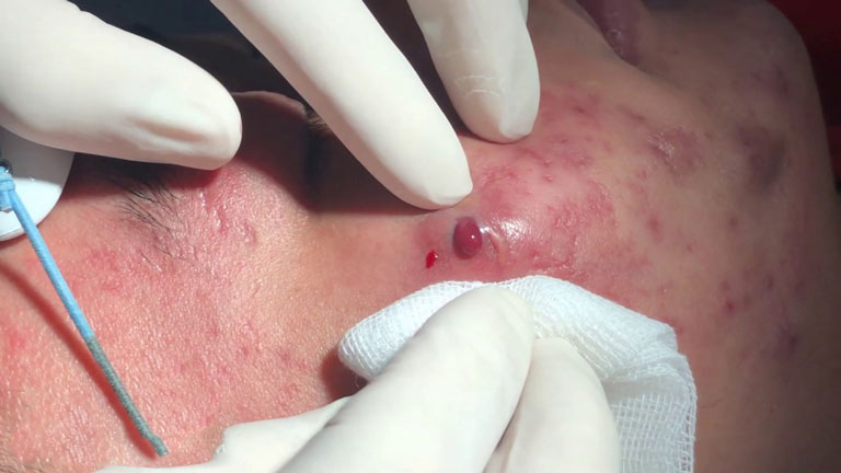 Nhân Mụn Trồi Lên Có Nên Nặn Không?