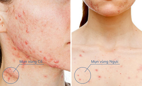 Nhân Mụn Trồi Lên Có Nên Nặn Không?