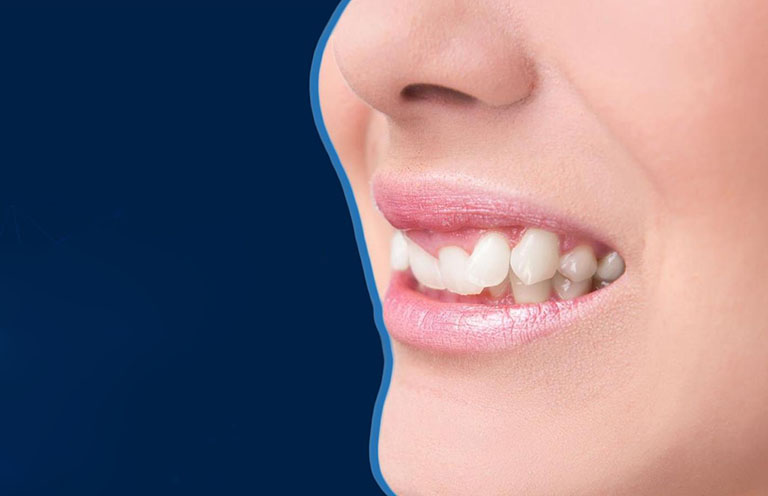 Răng Khểnh Có Nên Niềng Không? Quyết Định Quan Trọng