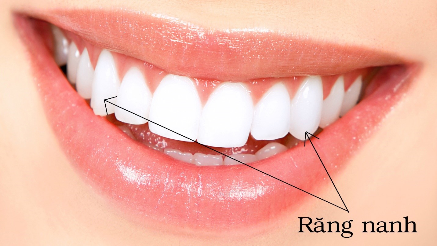 Răng Khểnh Có Nên Niềng Không? Quyết Định Quan Trọng