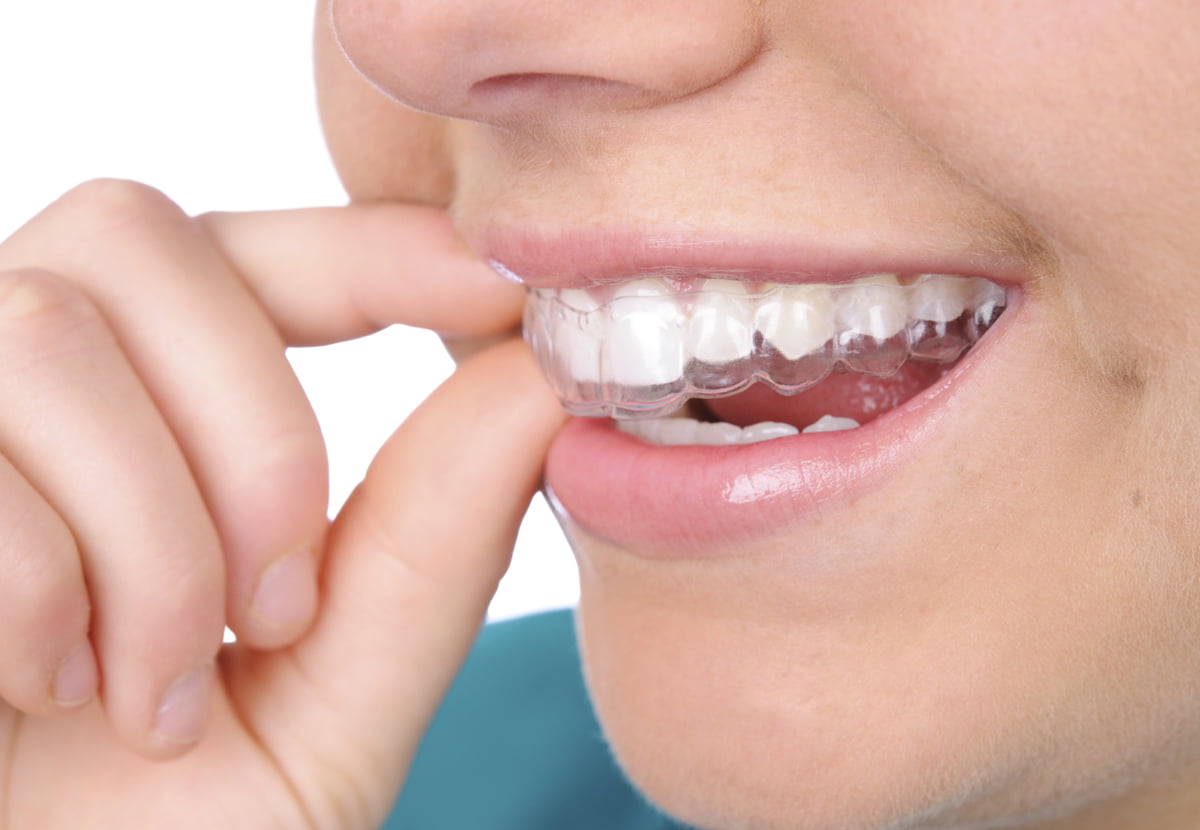 Răng Khểnh Có Nên Niềng Không? Quyết Định Quan Trọng