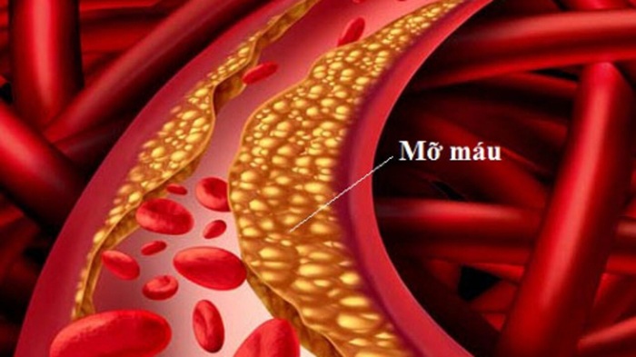 Motarin Hỗ Trợ Giảm Mỡ Máu, Ổn Định Huyết Áp Bằng Thảo Dược 2 Motarin Hỗ Trợ Giảm Mỡ Máu